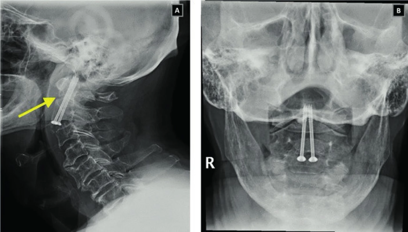 Cervical spine x-ray images in lateral (A) and transoral projec­tion in a patient after direct compression odontoid osteosynthesis. The arrow shows the location of the fracture