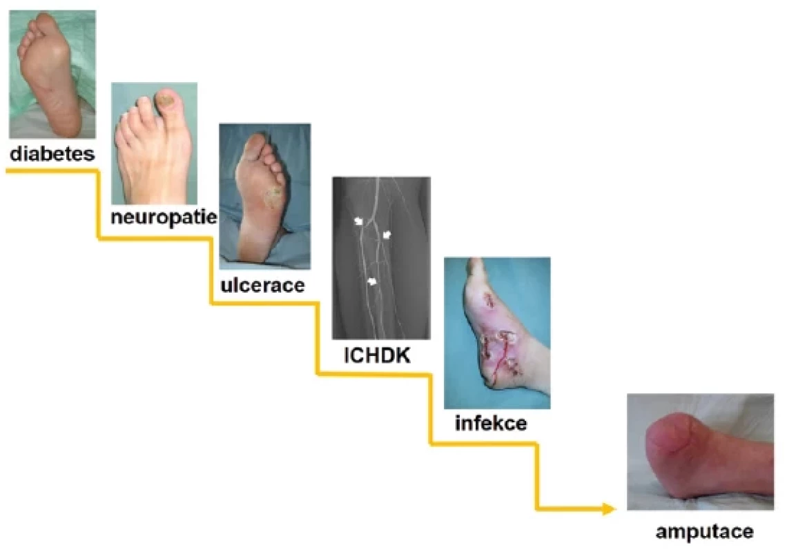 Patogeneze syndromu diabetické nohy a úloha infekce v tomto procesu, tzv. schody k amputaci