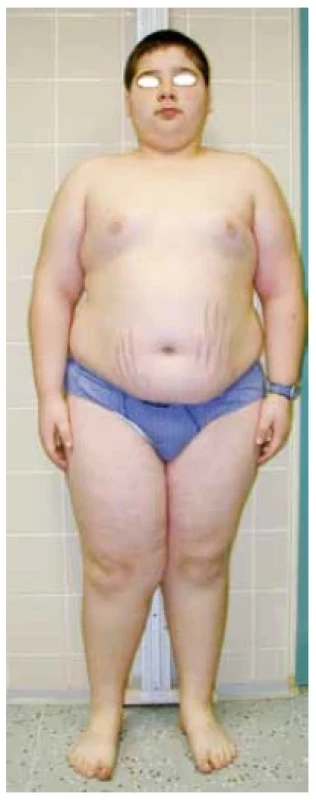 11letý pacient s plně
rozvinutým obrazem Cushingova
syndromu včetně obezity,
purpurových strií, měsícovitého
obličeje, izosexuální pseudopuberty
a poruchy růstu
(foto archiv autorů)