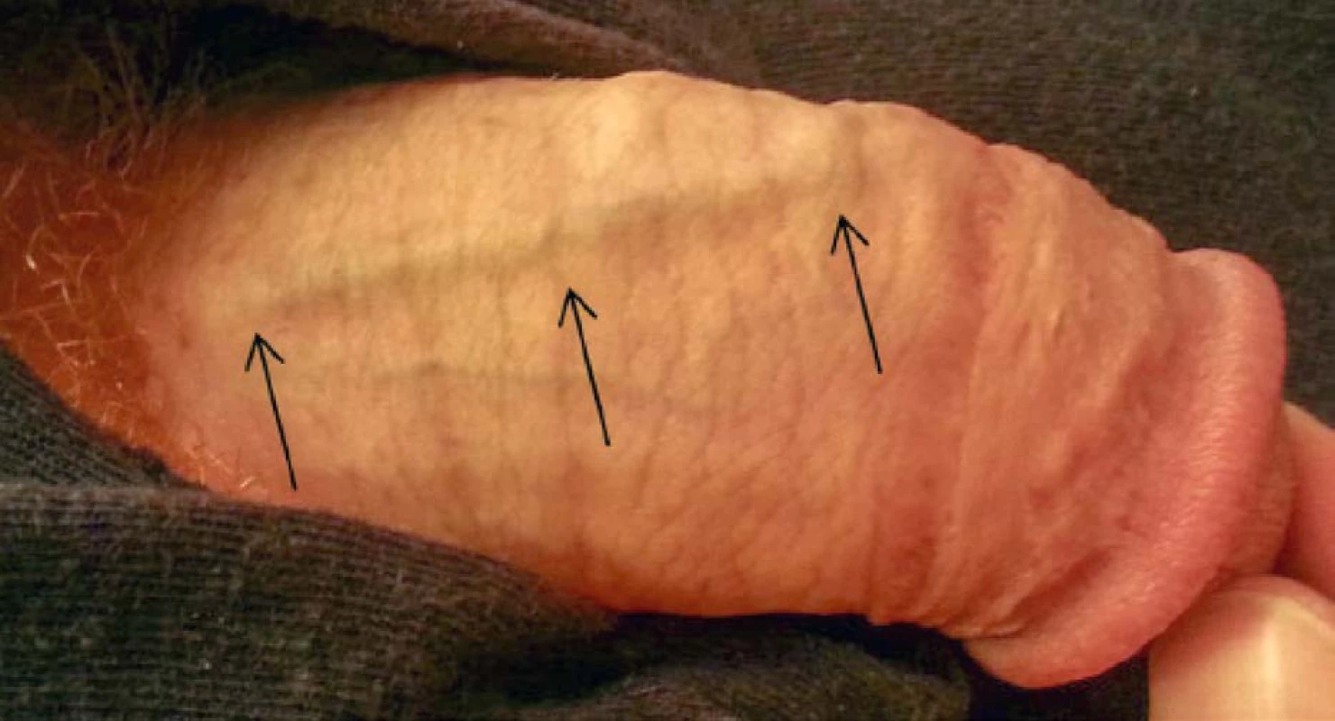 Tuhý pruh v průběhu dorzální žíly – Ilustrativní foto – zdroj (9)<br>
Fig. 1. Palpable rigid stripe affecting the dorsal vein