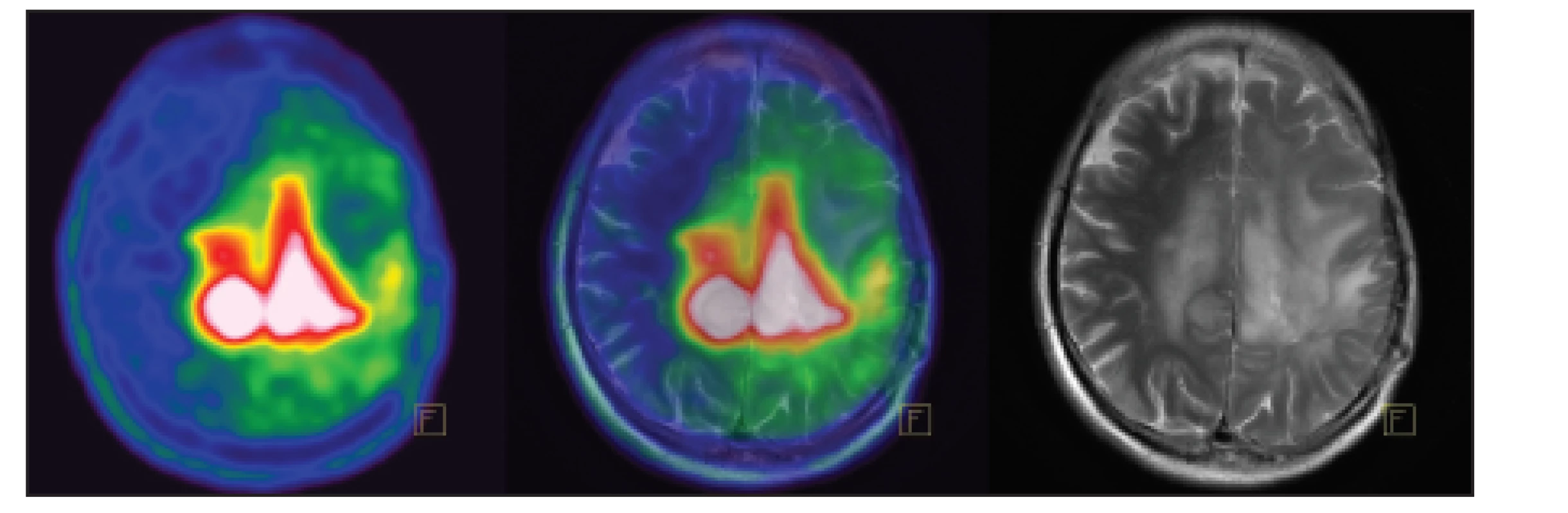 Pacient s astrocytomem G2 vlevo. V MET PET obrazu patrný přesah patologické akumulace přes střední čáru a větší
rozsah než v MR obrazu.