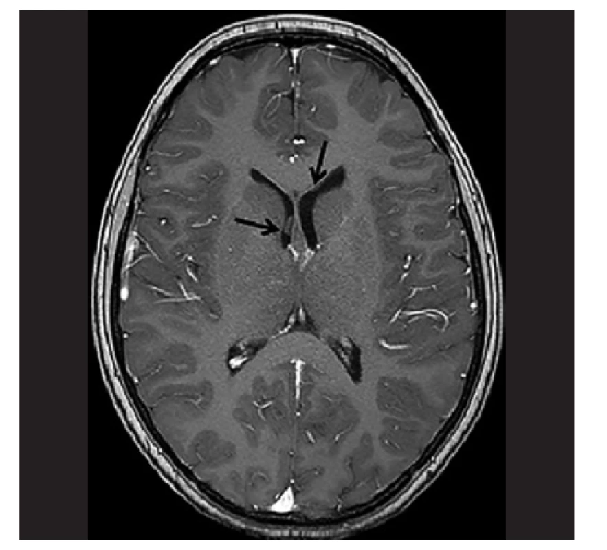 MRI pacientky s LGG s prokázaným fúzním genem BCR1-NTRK3. Na
MRI mozku se zaměřením na zrakovou dráhu byl nález solidní patologické
expanze v oblasti optického chiasmatu s propagací suprachiasmaticky, ventrálně
do oblasti baze frontálního laloku vlevo a dorzálně do oblasti mediální
části temporálního laloku a insuly vpravo.