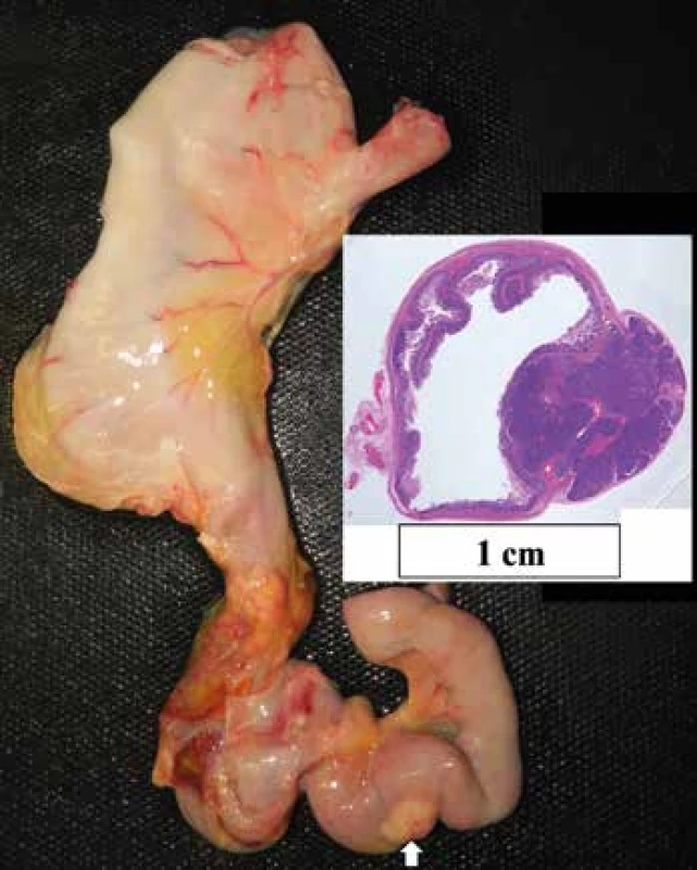 Heterotopia tkaniva pankreasu v prvej jejunálnej kľučke. Vložený
obrázok histotopogram heterotopie.