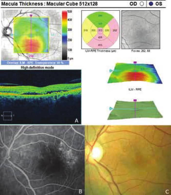 Recurrence of central serous chorioretinopathy after 5 years