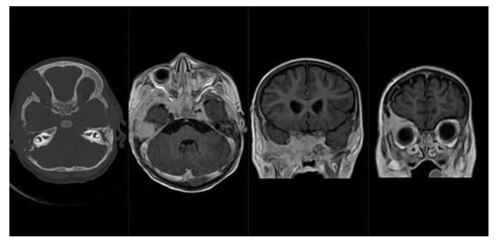 LCH baze lební: a) nativní CT scan v kostním okně, osteolytické léze pravé frontální kosti, zevní porce
pravé temporální kosti a sfenoidální kosti vlevo, b) MR scan – T1 sekvence po podání kontrastní látky v axiální
rovině, solidní měkkotkáňové sytící se expanze baze lební v rozsahu sfenoidálních a temporálních kostí
oboustranně, c, d) MR scan – T1 sekvence po podání k. l. v koronární rovině, sytící se expanze baze lební
a stropu pravé orbity.<br>
Fig. 4. LCH of skull base: a) CT scan – bone window, lytic lesions of frontal bone, temporal bone on the right
side and sphenoid bone on the left, b) MR scan – T1 after contrast medium injection, axial plane, soft tissue
tumors of skull base, c, d) MR scan – T1 after contrast medium injection, coronal plane, enhansing tumor of
skull base and the right orbit ceiling.