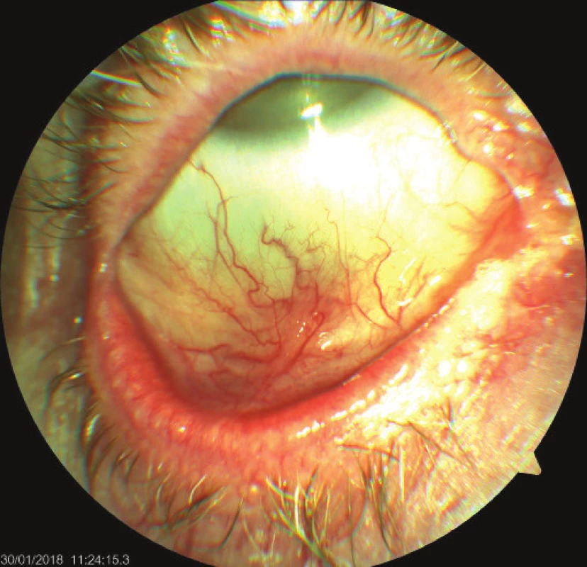 Right eye of patient – cicatrising blepharoconjunctivitis,
whitish plaques on edges of eyelids, symblepharon
later appearing