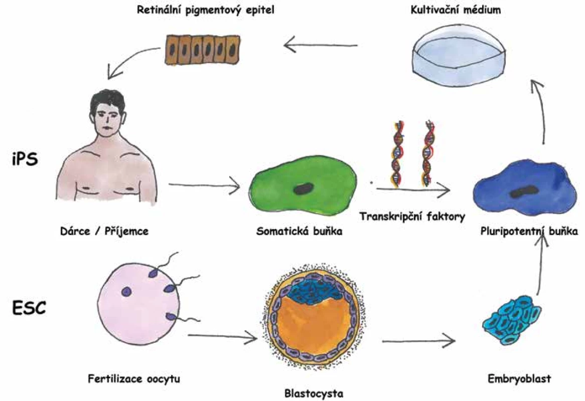 Základní rozdíly mezi buňkami retinálního pigmentového epitelu (RPE) z embryonálních kmenových buněk a indukovaných pluripotentních kmenových buněk. Zatímco indukované pluripotentní kmenové buňky získáváme ze somatických buněk, typicky mezenchymových buněk kůže dárce (v případě autologní transplantace je  dárce zároveň příjemce), buňky embryonální odebíráme z blastocysty po fertilizaci oocytu. Následně pluripotentní buňky kultivujeme za působení vhodných růstových mediátorů směrem do RPE