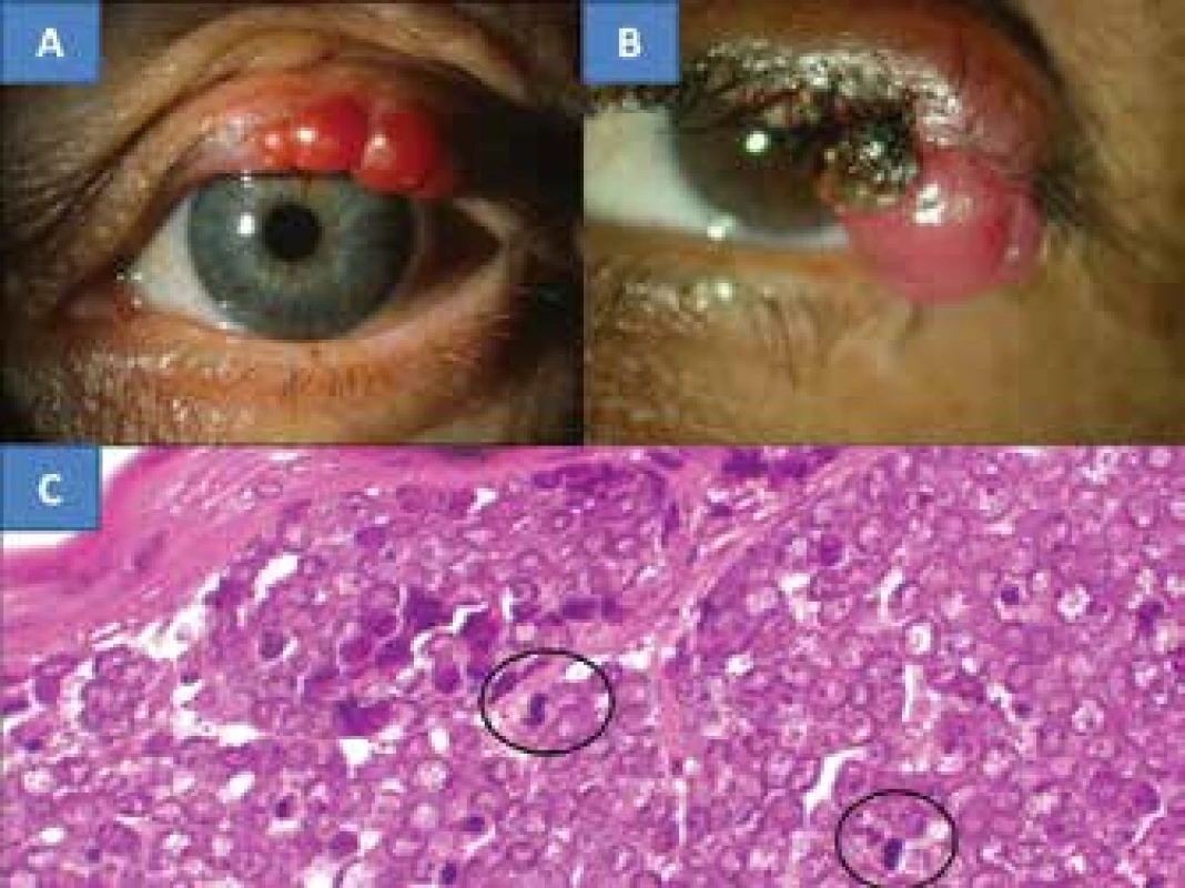 4. MCC of the eyelid in a 78 year old patient (A), MCC of the
eyelid in a 67 year old patient (B), the characteristic histological
finding of MCC is formed by oval, non-dendritic, epidermal clear
cells with mitoses – indicated with a circle (C), HE colouring, enlargement
300x