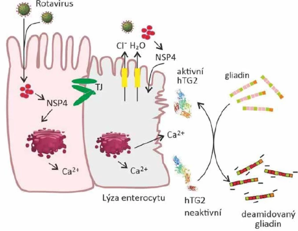 Možný mechanismus vlivu rotavirové infekce na rozvoj celiakie</br>Figure 6. Mechanism of possible involvement of rotavirus infection in celiac diseas