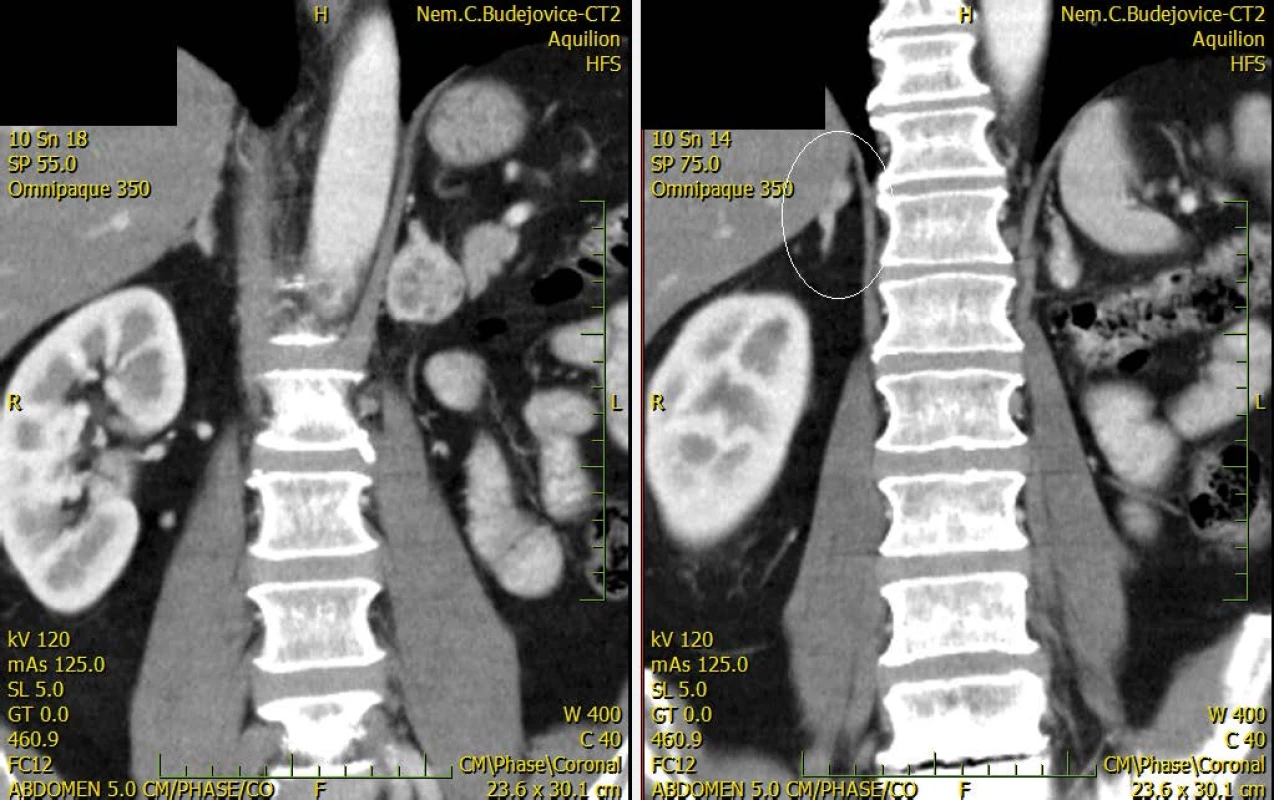 CT zobrazující bilaterální metastázy nadledvin<br>
Fig. 2. CT scan showing bilateral adrenal metastaseis
