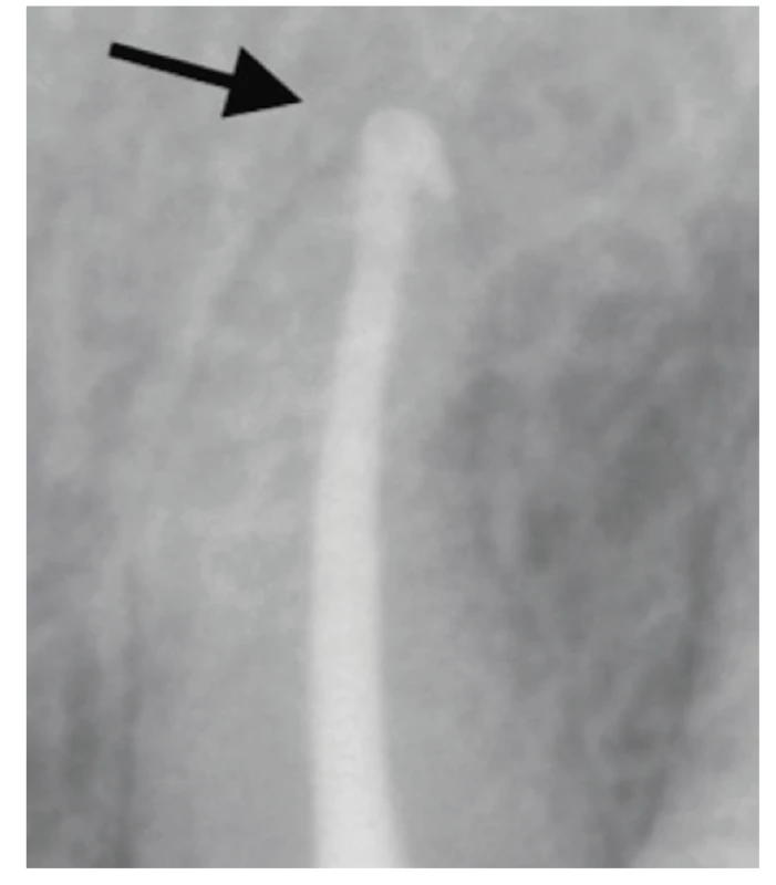 Kontrolní RTG snímek po deseti měsících s viditelným náznakem hojení v apikální oblasti <br>
Fig. 12 Control X-ray after ten months with visible sign of healing in the apical area