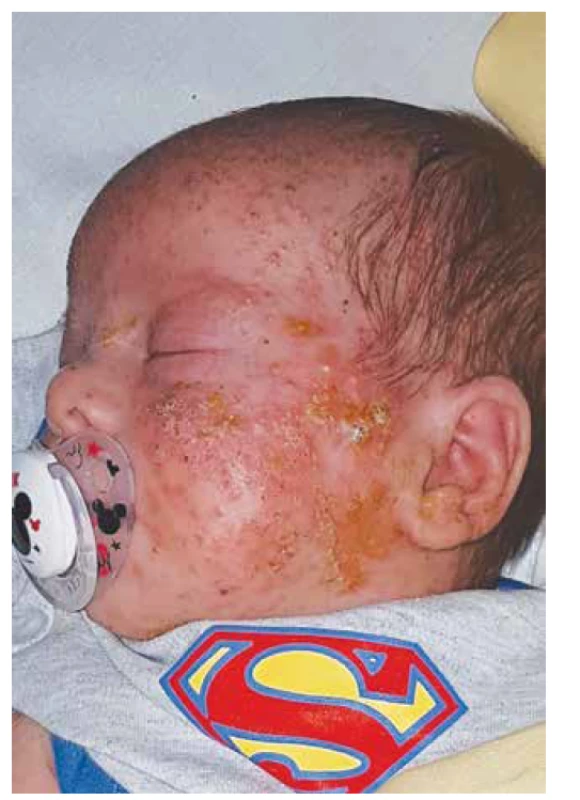 AD hyper-IgE syndrom, folikulární papulopustulóza
v kojeneckém věku.<br>
Fig. 4. AD hyper-IgE syndrome, follicular papulopustulosis in
infancy.