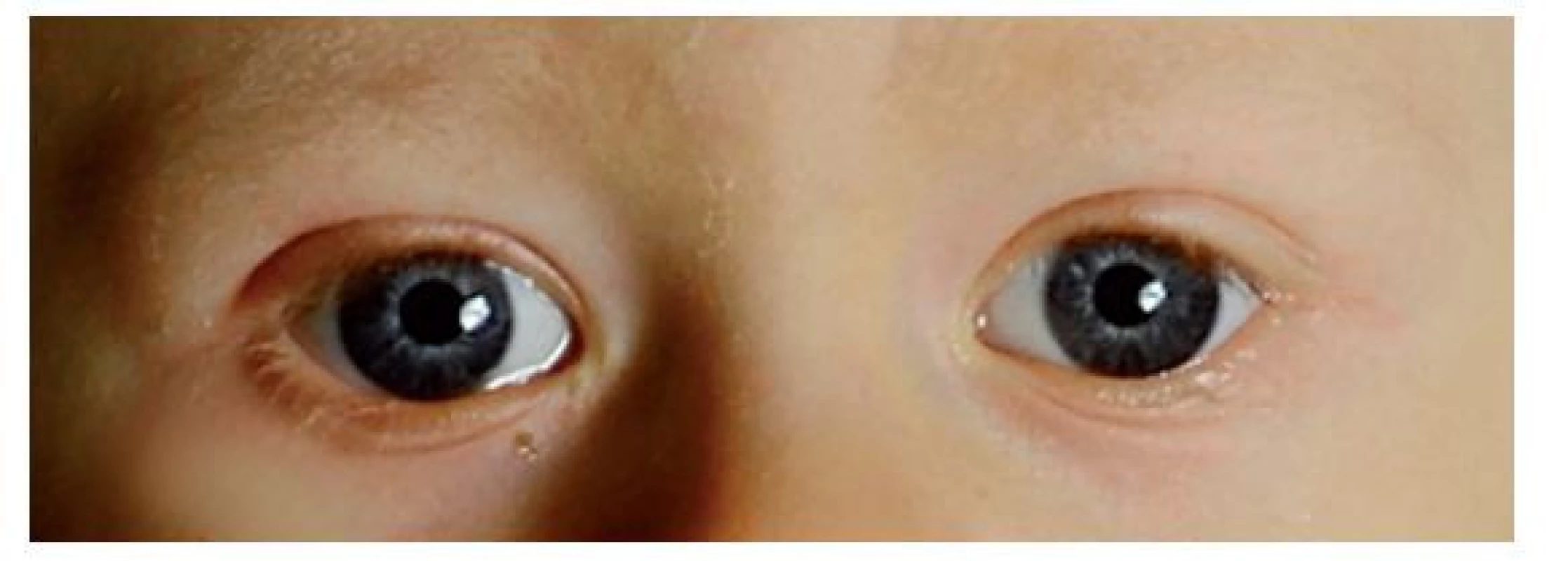 Hvězdicovitý vzor na duhovkách u dvouletého chlapce s diagnostikovaným
WBS – iris stellatae