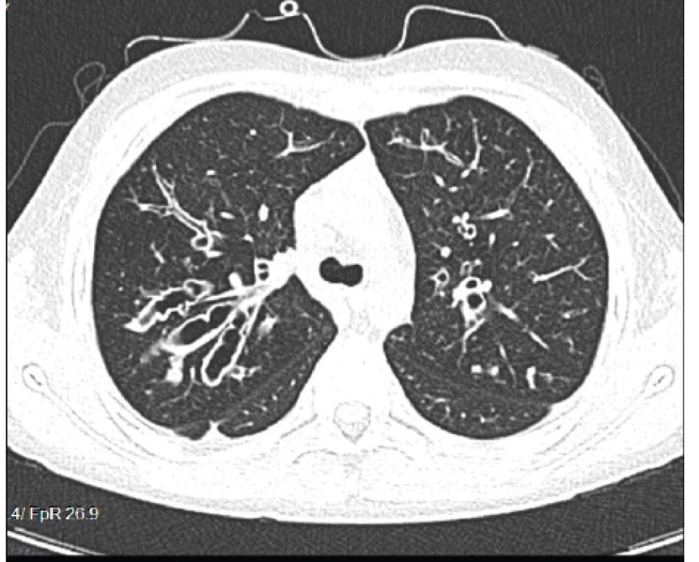 Cylindrické až varikózne bronchiektázie prítomné
u nášho pacienta (#004).<br>
Fig. 6. Cylindrical and varicose bronchiectases present in our
patient (#004).