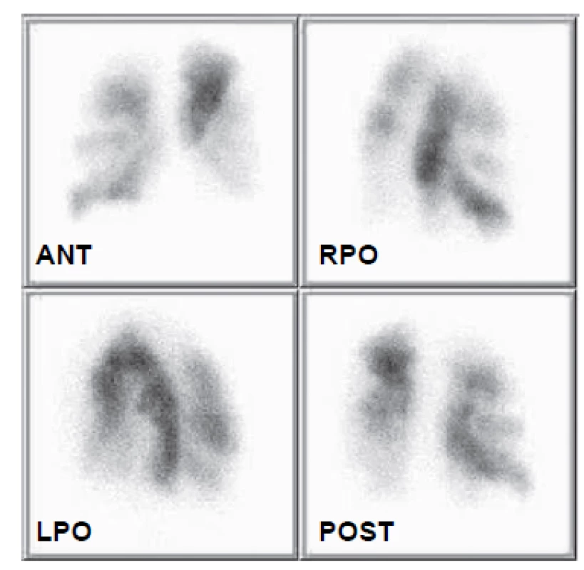 Scintigrafie plicní perfuze 5. 3. 2008. Jasně jsou patrné segmentové
defekty perfuze v obou plicních křídlech.
