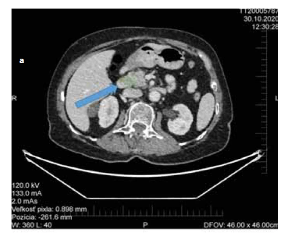 a) CT abdomenu s nálezom Tu pankreasu bez regionálnej
lymfadenopatie.<br>
Fig. 1a) Abdominal CT with pancreatic cancer without sign of
regional lymphadenopathy.