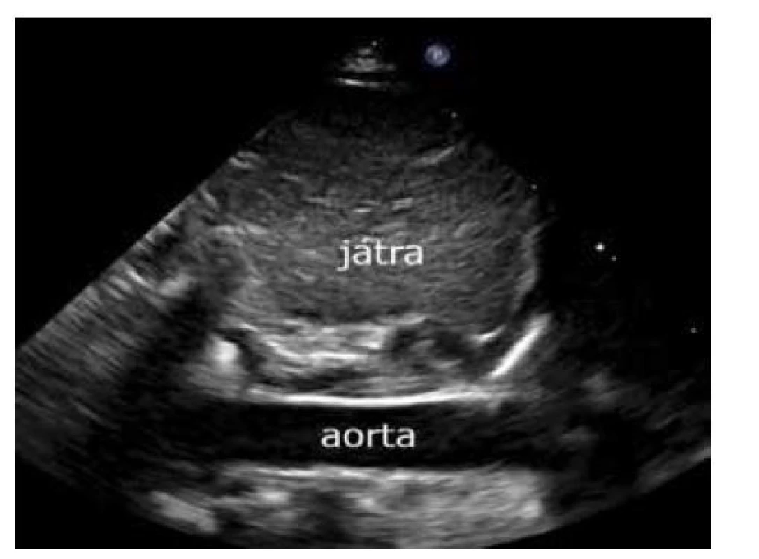 Subkostální projekce – sagitální zobrazení břišní
aorty