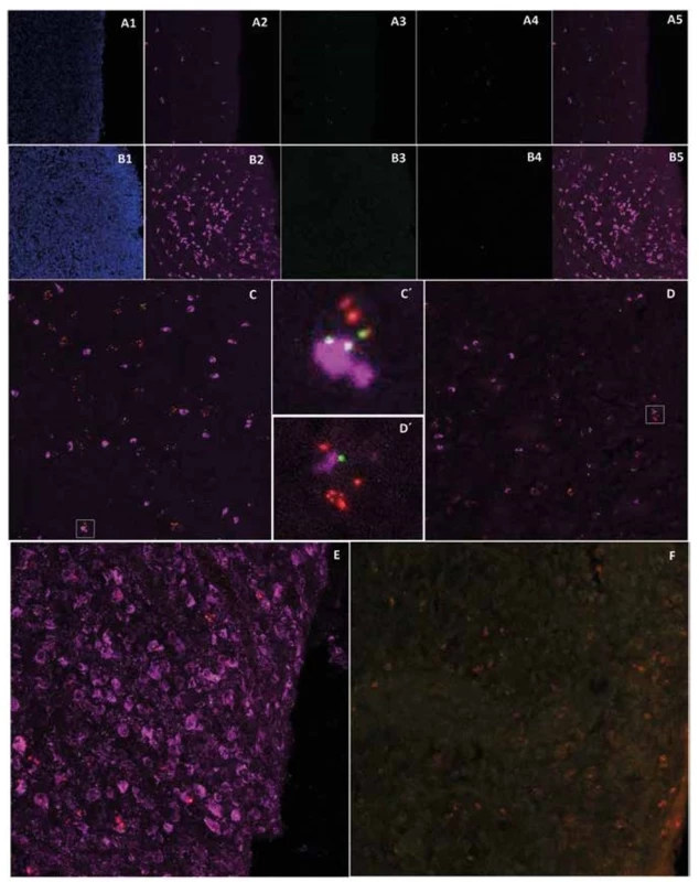 Immunofluorescent detection of pan-cytokeratin, cytokeratin 14 and macrophages in post-CED defects of animals
L139 and T61<br>
Expression of pan-cytokeratin in post-CED defect submucosa close to cicatricial mucosa of animal L139 (A2, 5, purple) and T61
(B2, 5, purple) (A1, B1 – DAPI channel; A3, B3 – pOKs, green; A4, B4 – MSCs, red; A5, B5 – merge of A2, 3, 4 or B2, 3, 4 channels; 400x
magnification). Expression of pan-cytokeratin (purple) and its co-localization with pOKs/MSCs aggregates in submucosa of animal
L139 ESD site (C, C´, 400x magnification). Expression of cytokeratin 14 (purple) and its co-localization with pOKs/MSCs aggregates
in submucosa of animal L139 post-CED defect. (D, D´, 400x magnification). Expression of macrophage marker (purple) in post-CED
defect site submucosa close to cicatricial mucosa of animal L139 (E) and T61 (F, almost negative) (pOKs – green, MSCs – red, 400x
magnification).