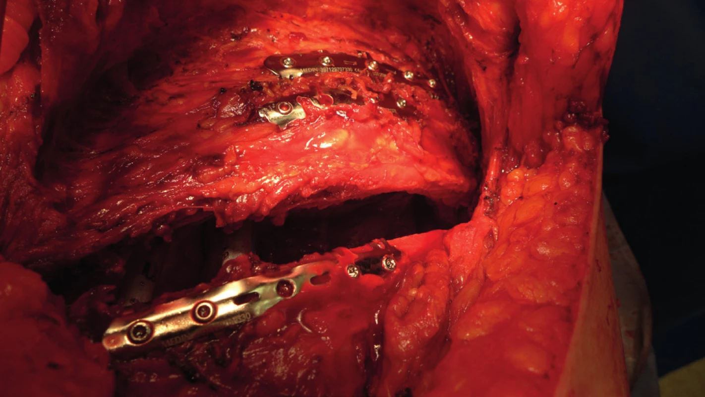 Peroperační snímek provedené osteosyntézy žeber inovovanými
dlahami Judetova typu před uzávěrem torakotomie