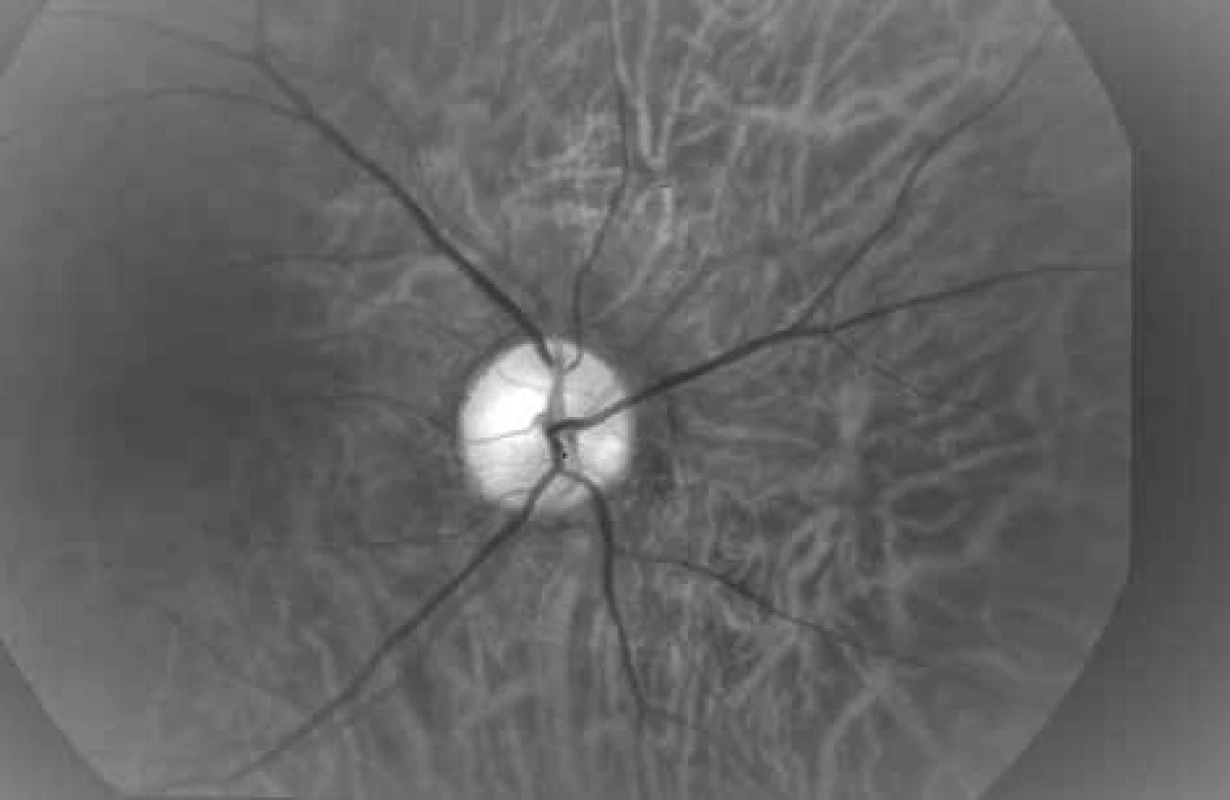 Photograph of ocular fundus at wavelength of 600 nm (same area as on Fig.
3 and 4).