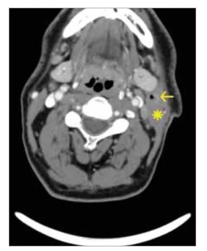 Axiální kontrastní CT sken.
Patrný lehce nehomogenní, na periferii
chabě a neúplně se sytící útvar
špatně zřetelných okrajů s centrálním
vzdušným projasněním (šipka), který
naléhá na přední okraj zánětlivě rozšířeného
m. sternocleidomastoideus
(hvězdička). V. jugularis interna je
stlačena dvěma zvětšenými
uzlinami.<br>
Fig. 2. Axial CT scan with contrast.
Slightly inhomogeneous, weakly and
incompletely enhancing formation of
poorly distinct margins on the periphery
with central aerial brightening (arrow),
adjacent to the anterior border
of the inflammatory thickened sternocleidomastoid
muscle (asterisk). The internal
jugularis is compressed by two
enlarged nodes.
