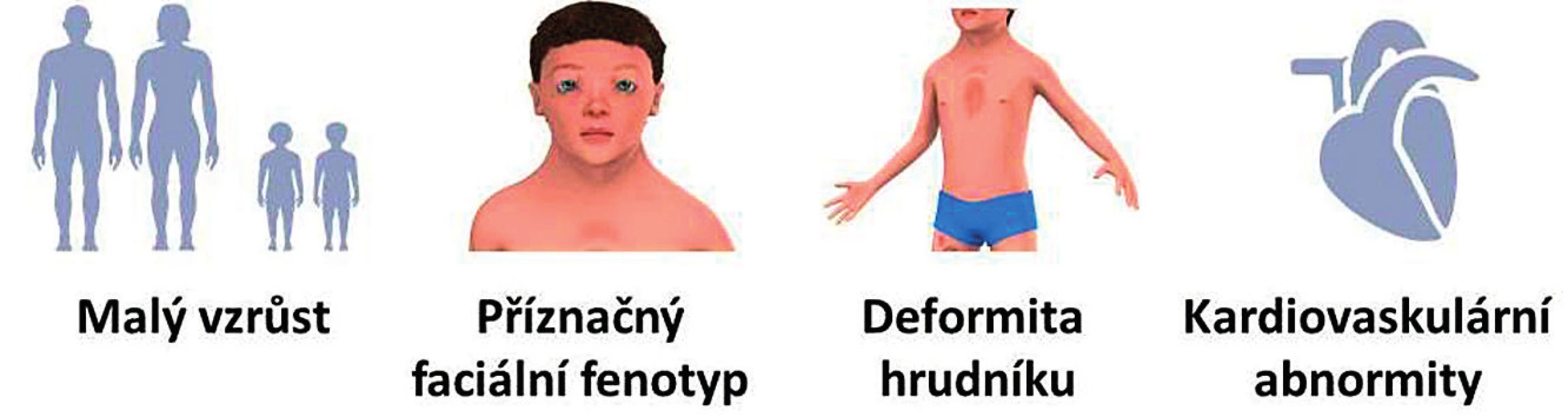 Hlavní klinické příznaky RASopatií/syndromu Noonanové.<br>
Fig. 1. Major clinical signs of RASopathies/Noonan syndrome.