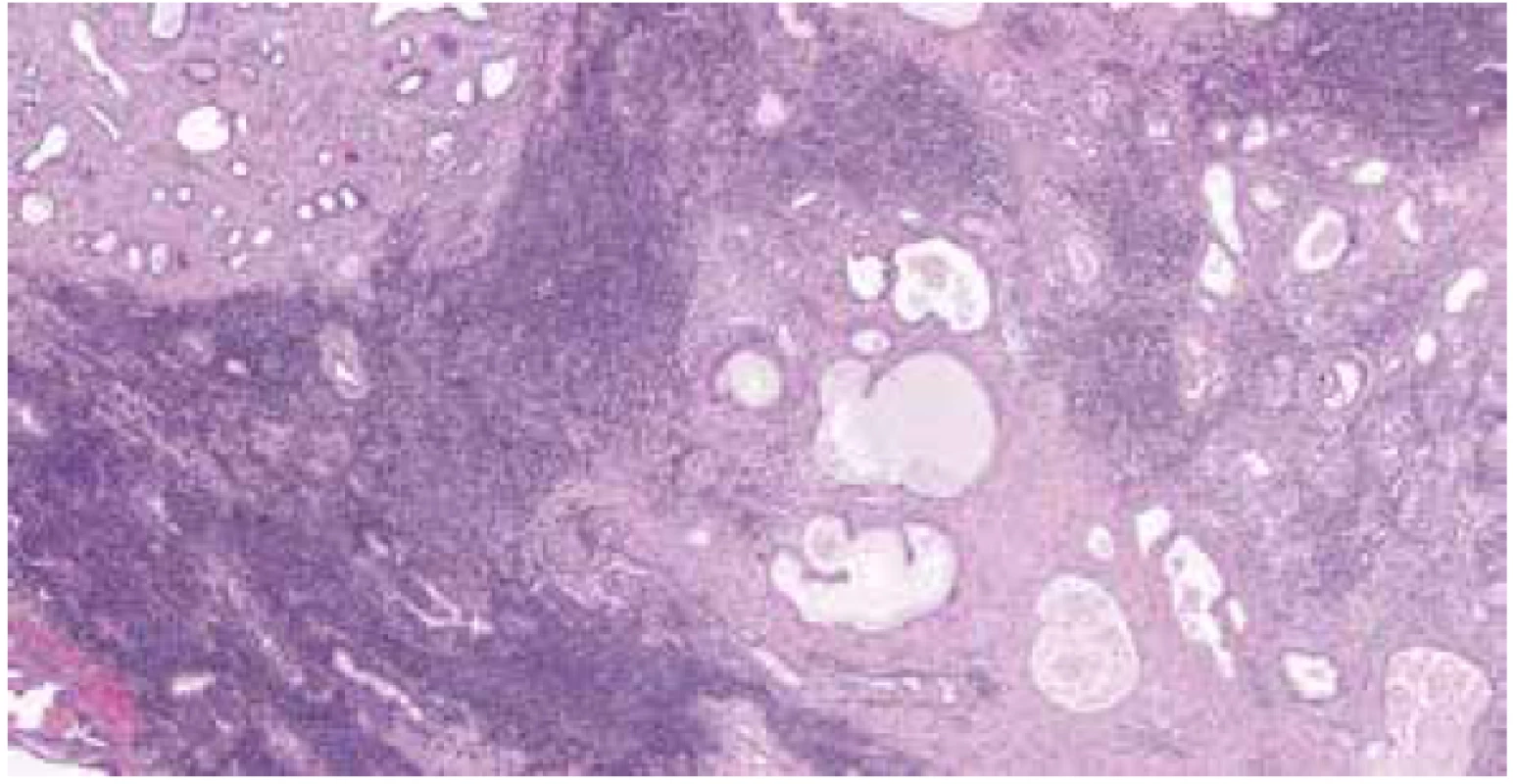 Stroma prostaty infiltrováno MCL. H&E (zvětšeno 40x).