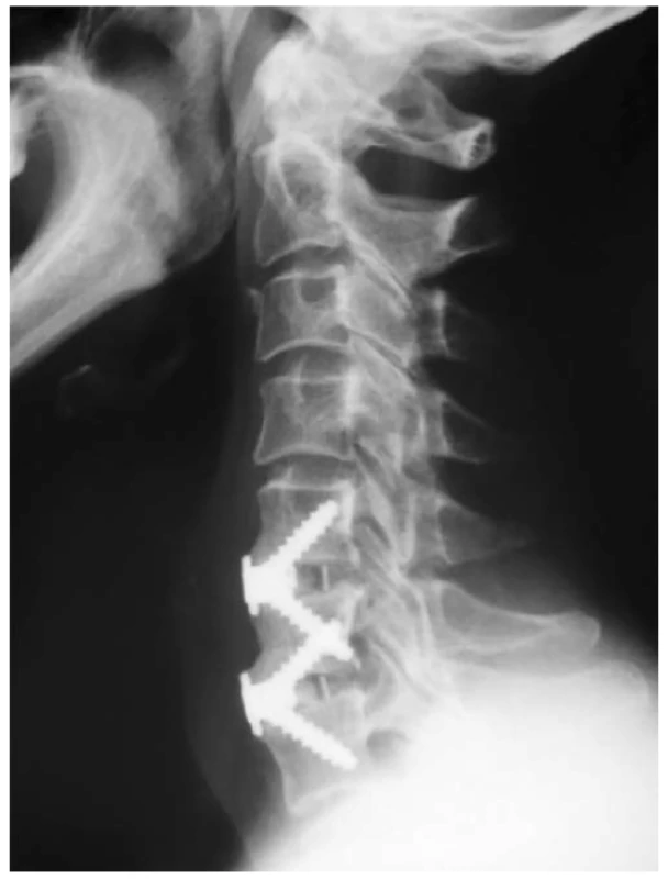 X-ray image after implantation of Zero Profi le VA cage
in levels C5-6, C6-7