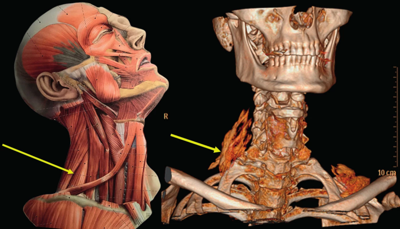 Fasciální prostor pro průběh n. thoracicus longus na krku.
Anatomický obraz a 3D rekonstrukce prostoru mezi m. levator scapulae
a m. scalenus dorsalis