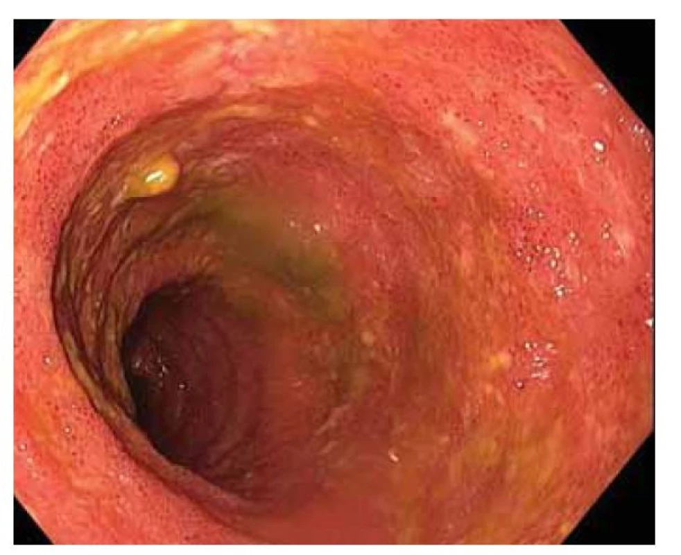 Endoskopie ileálního vaku („pouchoskopie“) a pohled
do přívodné kličky.
Fig. 2. Ileal sac endoscopy (“pouchoscopy”) and a view into
the supply loop.