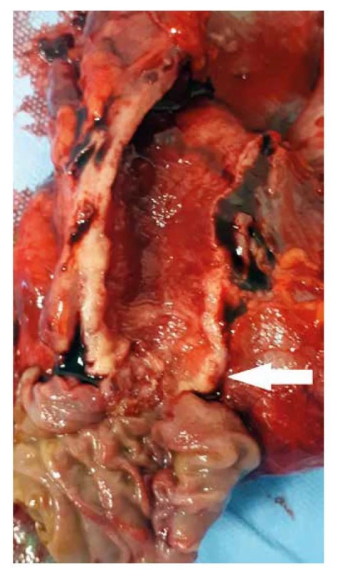 Pravostranná pankreatoduodenektomie, resekát
s cholangiokarcinomem distálního žlučovodu (bílá šipka)<br>
Fig. 1: Pancreatoduodenectomy, specimen with distal
bile duct cholangiocarcinoma (white arrow)