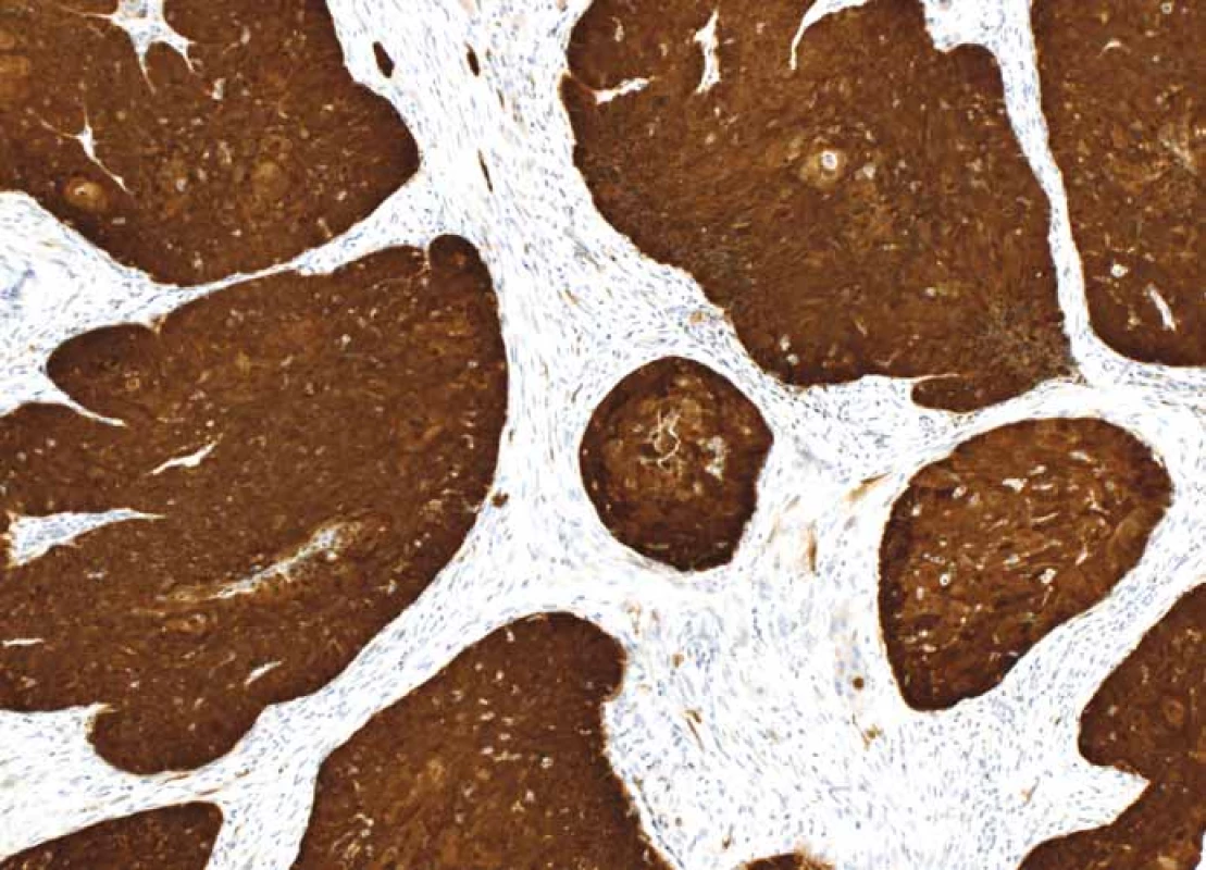 p16+ dlaždicobuněčný karcinom orofaryngu – silná difuzní exprese p16 v nádorových
buňkách, zvětšení 100×.