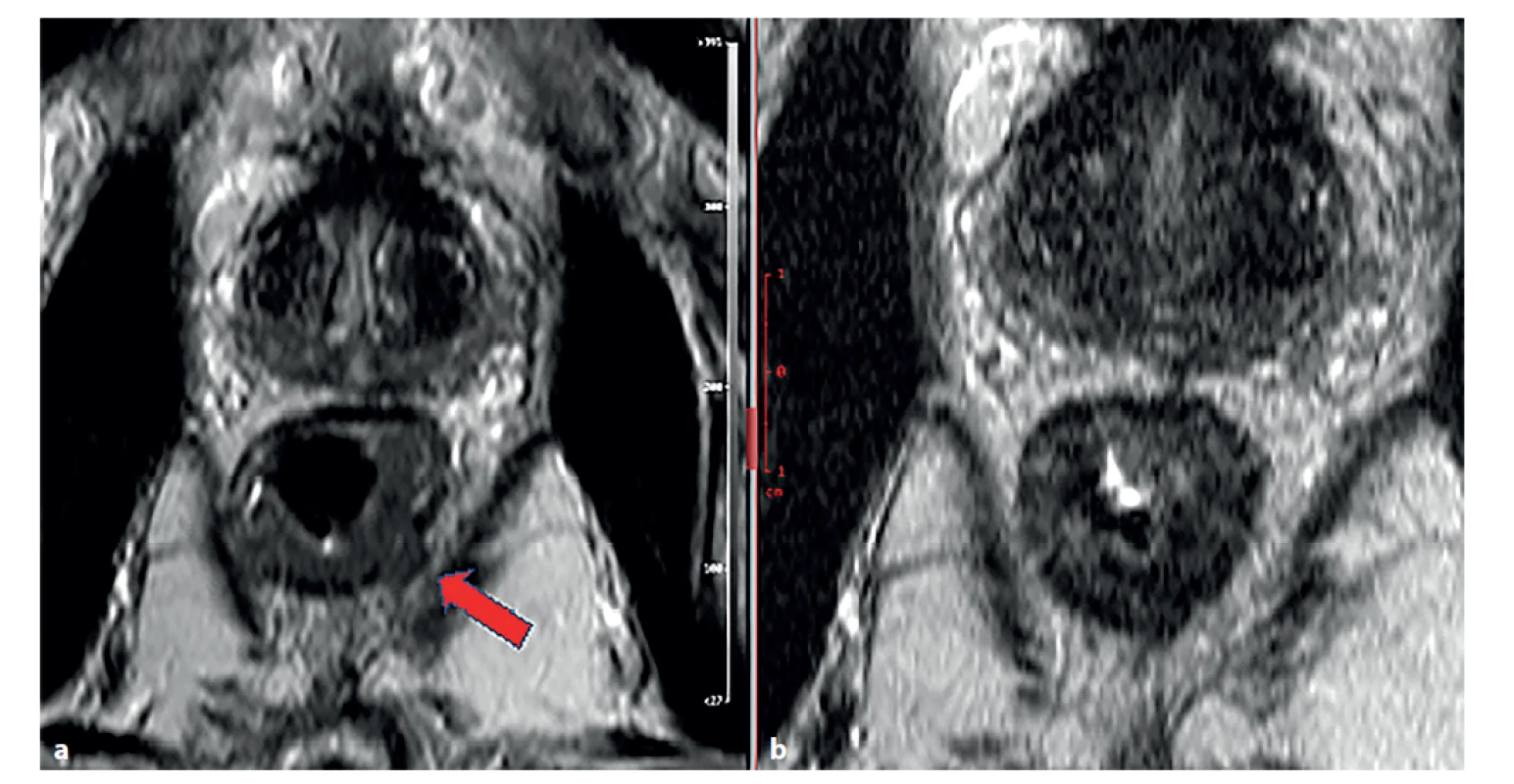 Magnetická rezonance rekta, T2 vážené obrazy v šikmé axiální rovině<br>
a) stagingové vyšetření − známky prorůstání tumorózní tkáně (střední intenzita signálu) přes muscularis propria (šipka), obraz T3b;<br>
b) restaging po chemoradioterapii.<br>
Došlo k poklesu signálu tumorózní tkáně (známka fibrotizace), bez známek prorůstání přes muscularis propria.<br>
Fig. 1: Magnetic resonance imaging of the rectum, T2-weighted images in inclined axial plane<br>
a) staging examination − signs of tumor growth (medium signal stength) through muscularis propria (arrow), figure T3;<br>
b) restaging imaging after chemoradiotherapy.<br>
Decrease in tumor tissue signal (sign of fibrotization), without signs of tumor growth through muscularis propria.