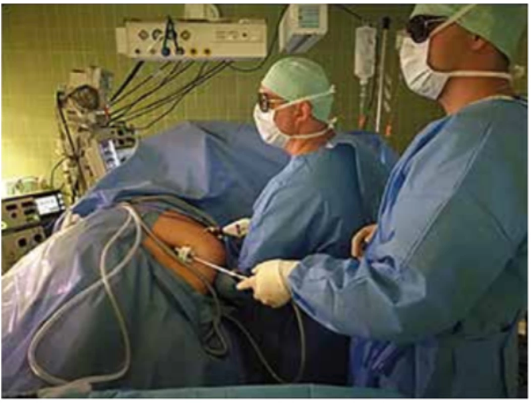 Ruka operatéra zavedená v dutině břišní pacienta
při HALS nefrektomii<br>
Fig. 1: Surgeon´s hand inside the patient´s abdominal cavity during HALS nephrectomy