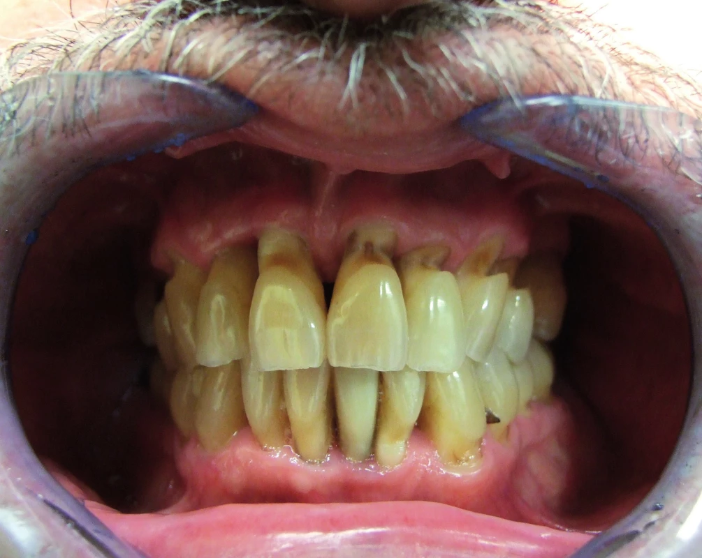 Pokročilé abrazivní defekty cervikální oblasti horních a některých dolních zubů v důsledku traumatizující techniky čištění zubů