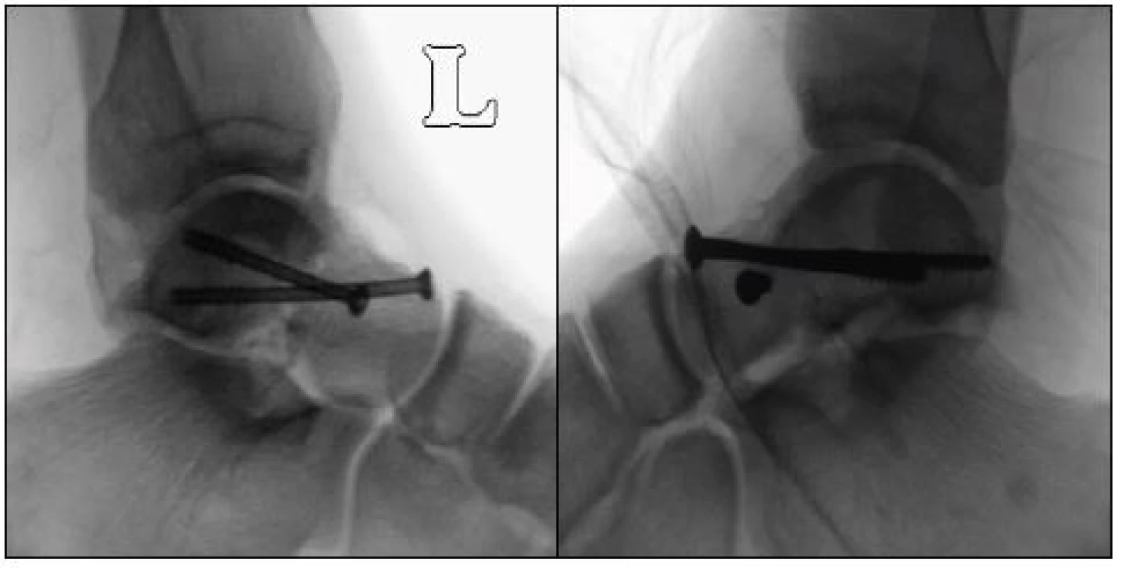 a, b: Postoperative radiographs of the ankle following osteosynthesis
with cannulated screws (4.0 mm)