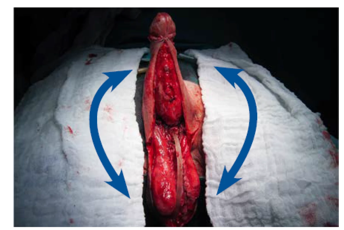 Stav po snesení granulační tkáně k úrovni Buckovy
fascie, příprava ventrální plochy skrota k odběru živených
laloků k vytvoření kompletního kožního krytu penisu<br>
Fig. 7. Transfer of two vascular skin flaps from the ventral
surface of the scrotum to the penis