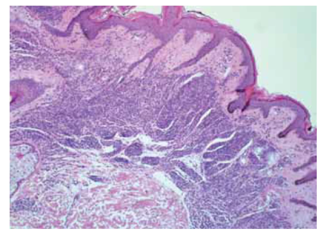 Intradermální melanocytární névus.<br>
Fig. 1. Intradermal melanocytic nevus.