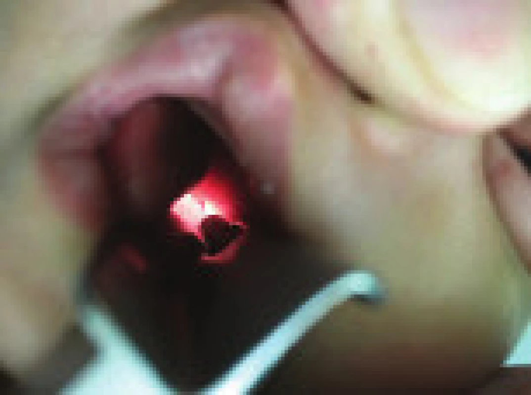 Uvula bifida u pacientky s Marshall/Sticklerovým syndrómom.