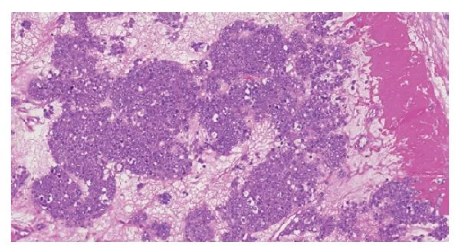 Anaplastický spermatocytický tumor. Histologicky jde o tumor uniformního
vzhledu, což je dáno přítomností pouze intermediárního typu buněk
(klasický spermatocytický tumor je charakterizován nádorovými buňkami
třech velikostí).