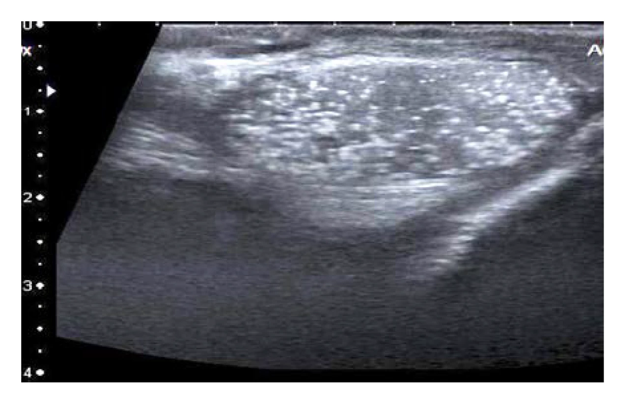 Ultrasonografický nález varlete postiženého
mikrolitiázou<br>
Fig. 1. The ultrasonographic image of testicular
microlithiasis
