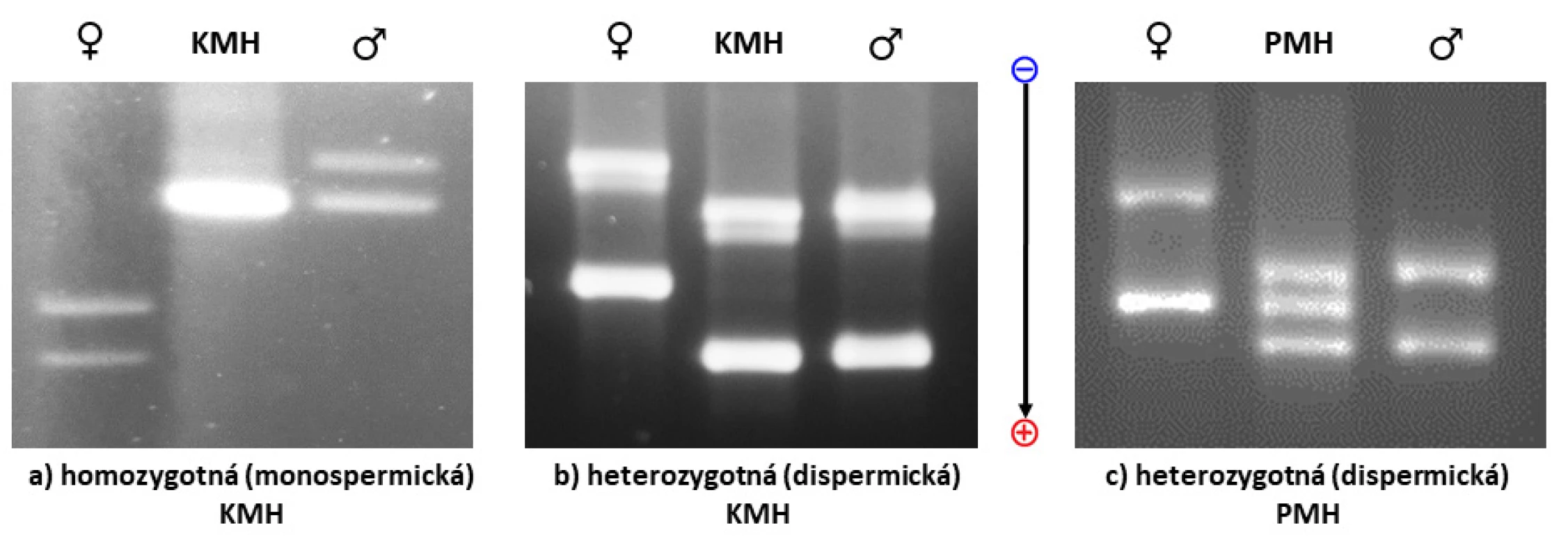 Analýza umožní porovnať profily DNA matky, DNA choriových klkov a prípadne aj DNA otca (KMH - kompletná mola hydatidóza,
PMH - parciálna mola hydatidóza)