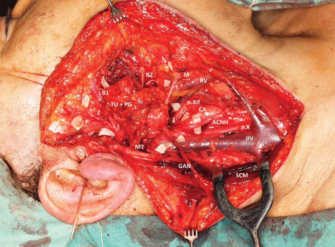 Intraoperative photo: Resection of parotid gland parenchyma
with tumour mass (TU+PG) invading the buccal branches
(B1, B2) and marginal branch (M) of the facial nerve. MT- main
trunk, F - frontal branch, Z -zygomatic branch, n.XII - hypoglossal
nerve, ACNH- ansa cervicalis n. XII, GAN - great auricular nerve,
JIV- internal jugular vein, n.X-vagus nerve, CA- carotid artery, RV -
retromandibular vein, SCM - sternocleidomastoid muscle