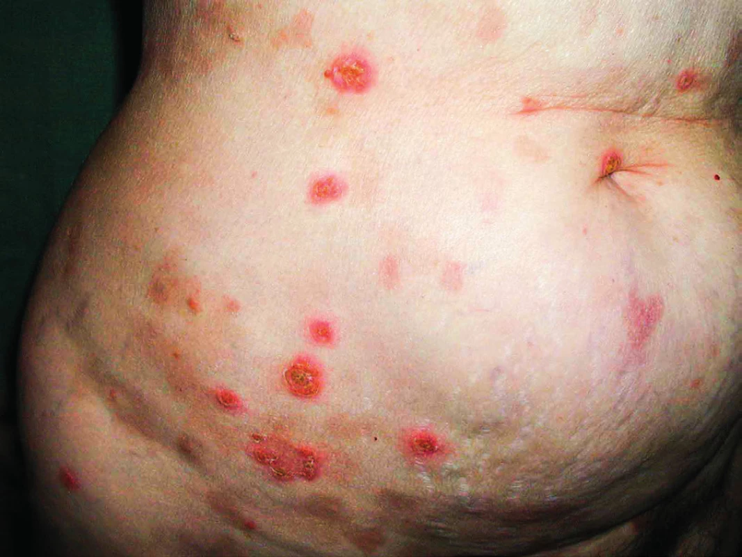 Kožní puchýřnaté onemocnění IgA pemfigus u pacientky
s mnohočetným myelomem