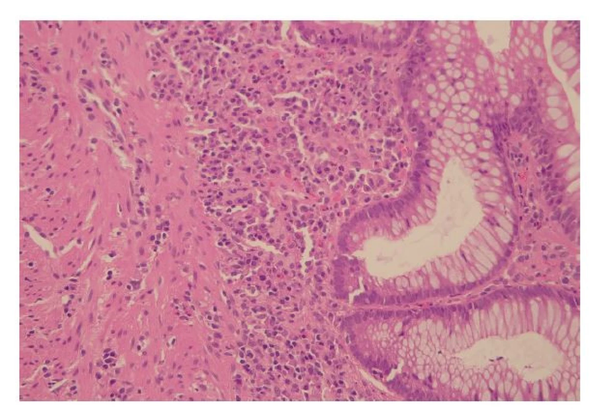 Bazální plazmocytóza v podobě početných plazmatických buněk nakupených
u báze lamina propria (hematoxylin a eosin, 400x).