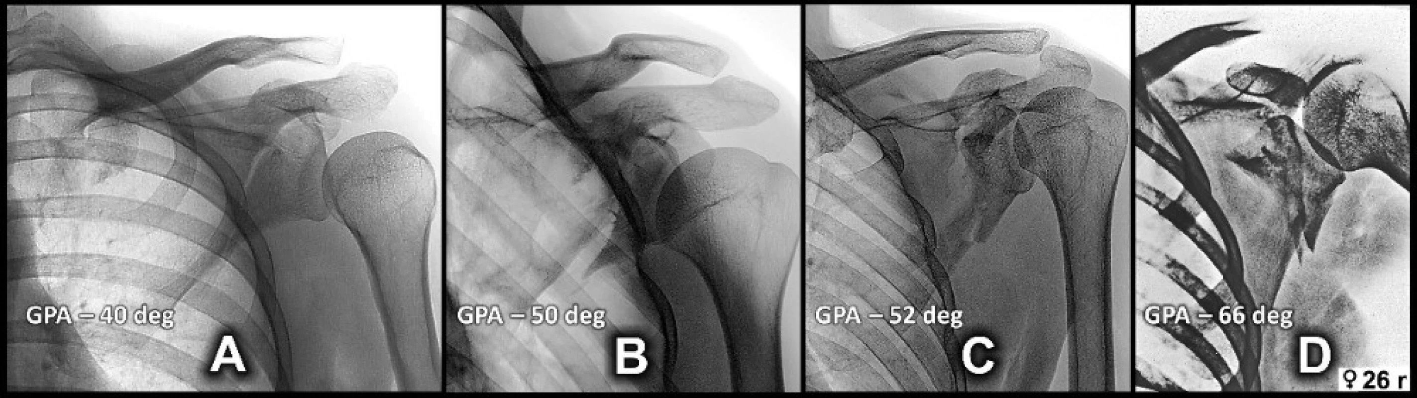 Comparison of the degree of displacement of the glenoid fragment, showing an increasing valgosity and widening
of a gap between the coracoid and the glenoid fragment. A – case 2; B – case 3; C – case 4, D – case 1