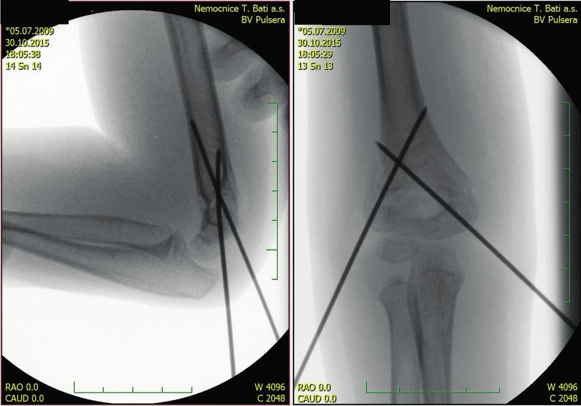 The same fracture - perioperative scan