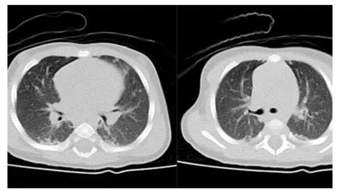 Postižení plic při LCH: a, b) nativní CT scany v axiální rovině, vícečetné drobné noduly
plicní tkáně oboustranně.<br>
Fig. 5. LCH lung disorder: a, b) CT scans in axial plane, some lung nodules on both sides.