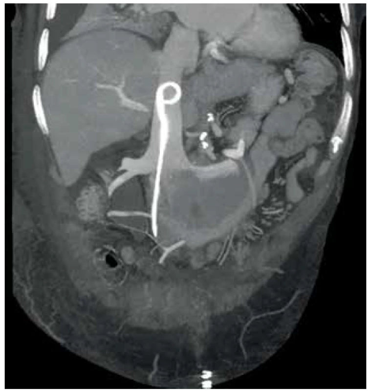 Uložení stentu v dolní duté žíle<br>
Fig. 1. Double J stent in the inferior vena cava