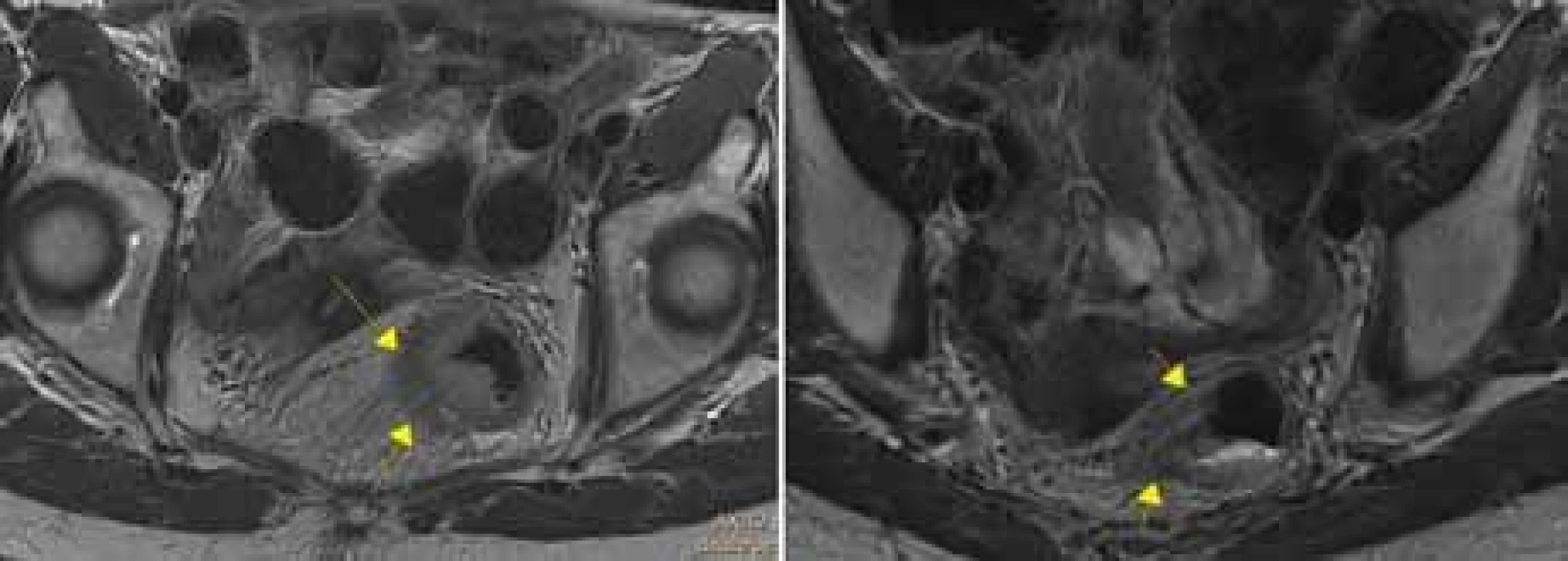 Vlevo: Vstupní MR vyšetření, tumorózní infi ltrace stěny rekta s prorůstáním
do okolního tuku, cT3b N2 M0. Vpravo: Kontrolní MR vyšetření po proběhlé neoadjuvantní radiochemoterapii, trvají patologické intenzity v přilehlém tuku, hodnoceno
jako ycTx N1 M0. Dle patologa po resekci ypT3 N0, stupeň regrese Dworak 1. 